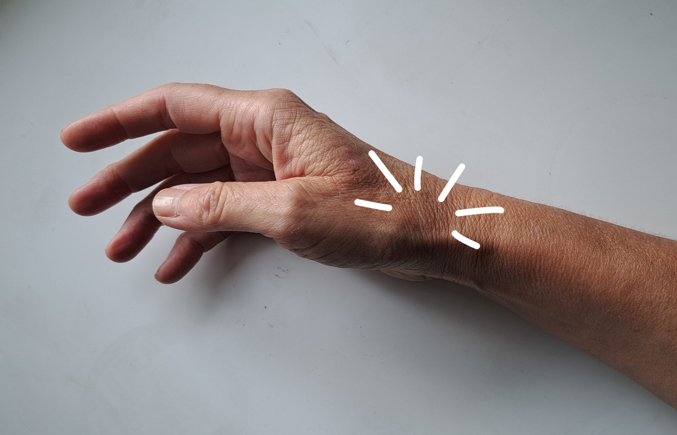 Handgelenk mit markiertem Bereich nach Fraktur und Gipsabnahme