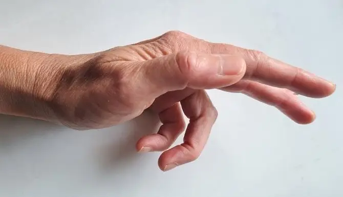 Hand mit beginnender Beugekontraktur bei Dupuytren